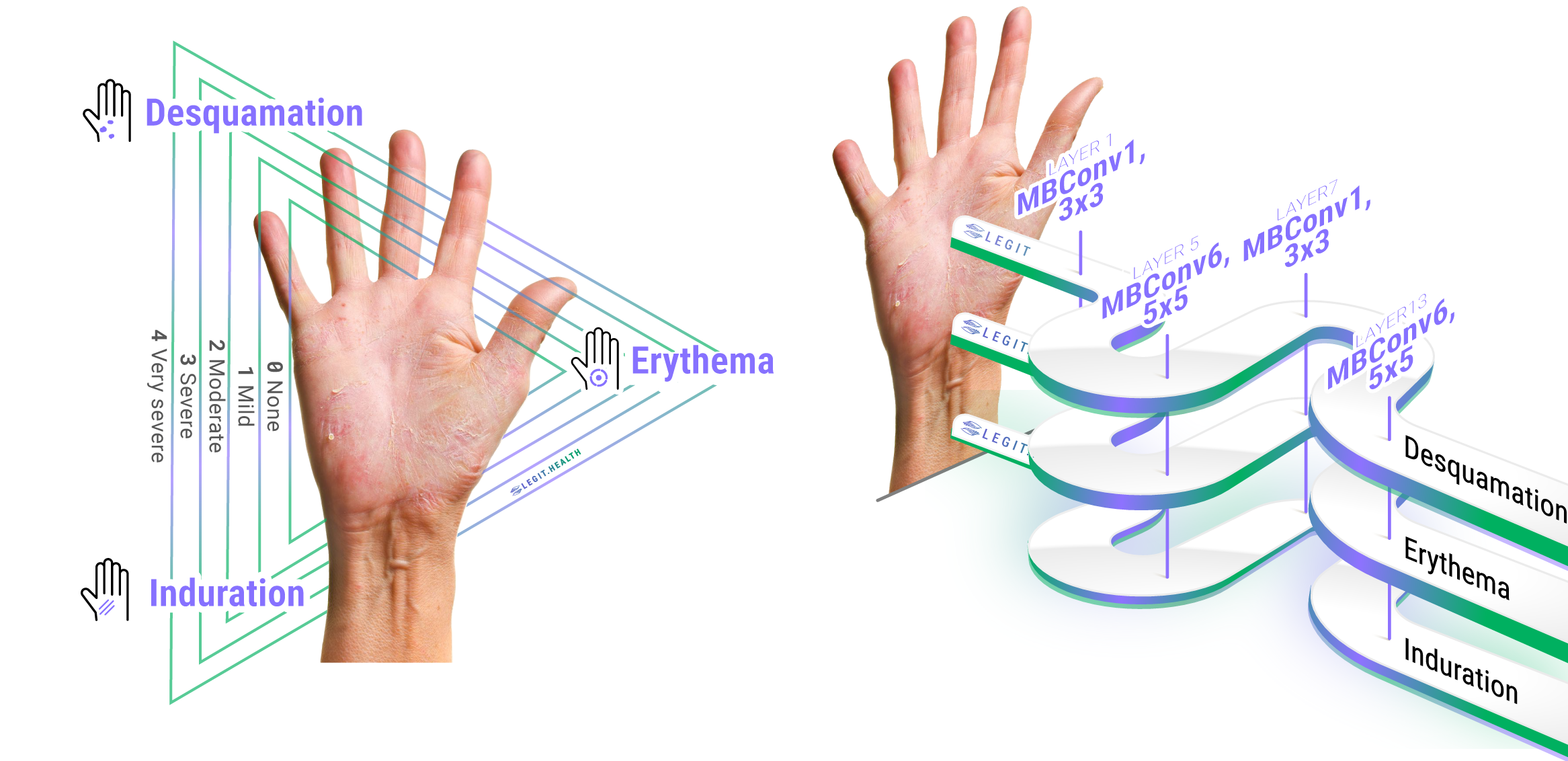 Infographic of the automatic psoriasis area and severity index