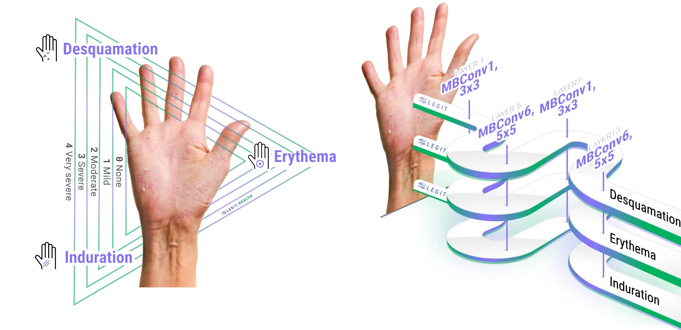 Infographic of the automatic psoriasis area and severity index